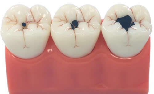 虫牙发展过程