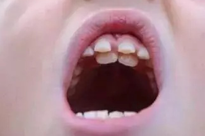 多生牙形态1