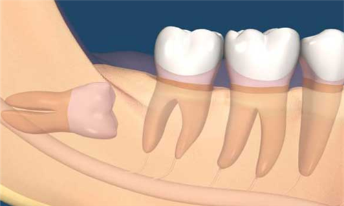智齿生长位置不正