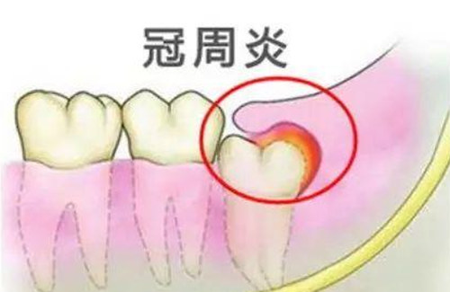 冠周炎