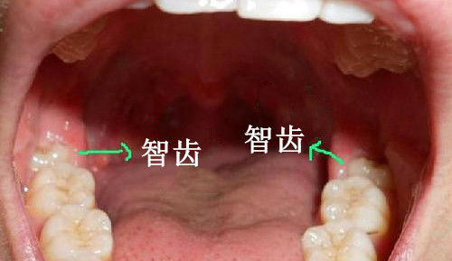 智齿