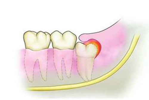 智齿冠周炎