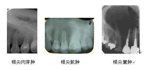 智齿根尖周炎