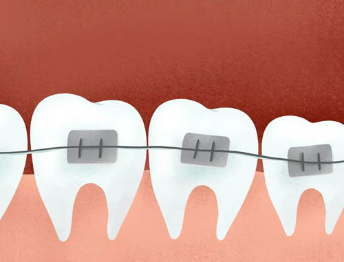 矫正牙齿避免哪些坑