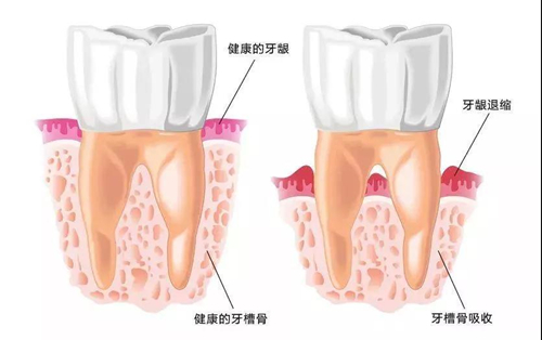 牙槽骨萎缩图