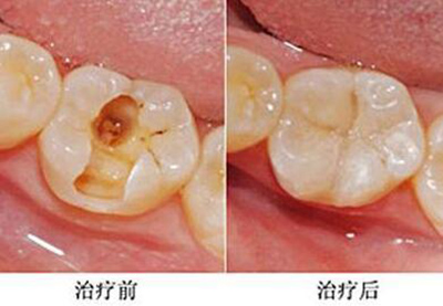 虫牙蛀牙补牙改善照片