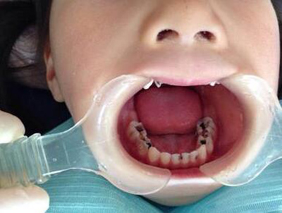 5岁孩子蛀牙有洞怎么办