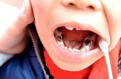 5岁孩子蛀牙有洞怎么治疗