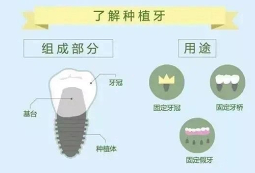 种植牙组成部分和用途图片