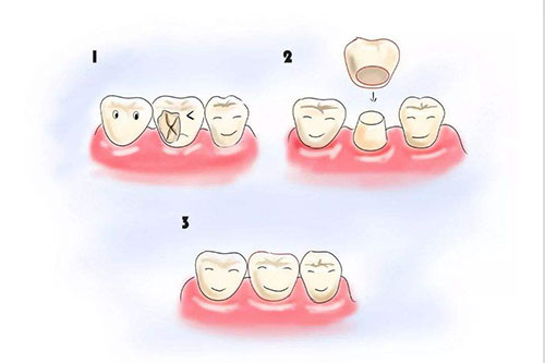 补牙示意图
