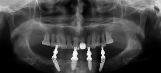 种植牙CT图