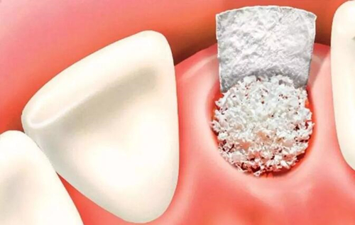 牙槽骨骨量增加的方法之植骨