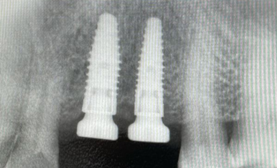 诺贝尔种植牙植入影像图