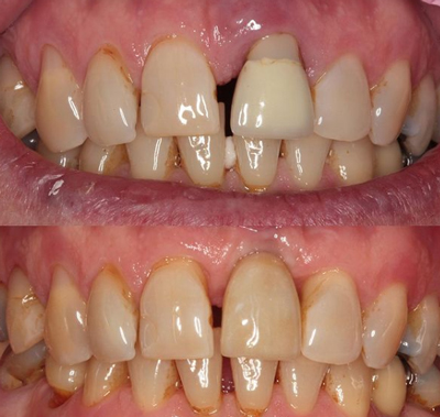 瑞士ITI门牙种植修复对比
