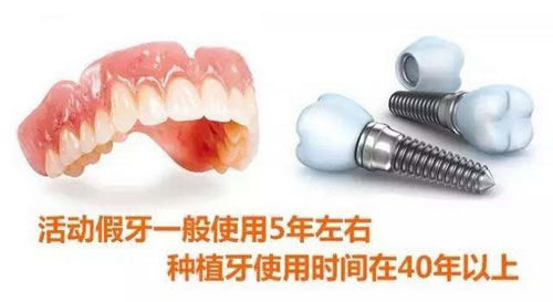 活动假牙与种植牙的使用寿命