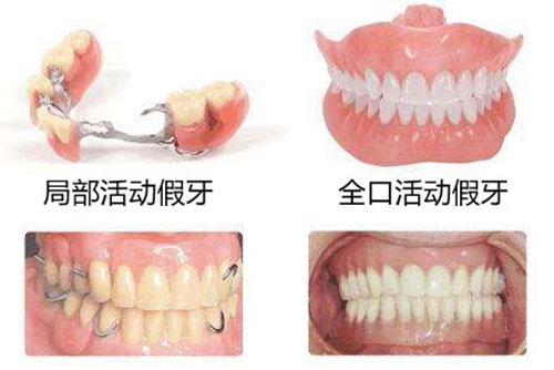 活动假牙和种植牙的区别示意图