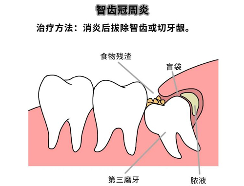 答疑:有智齿可以矫正牙齿吗?牙疼能正畸嘛?正畸拔牙会变成瘪嘴吗