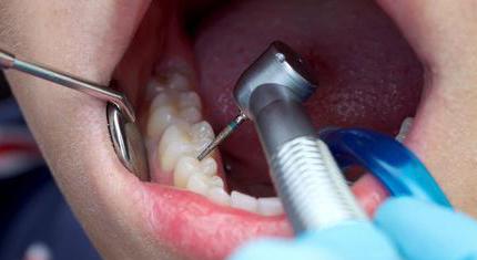 补牙前清理龋齿部分