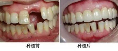 门牙种植前后对比照片