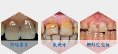 四环素牙氟斑牙以及牙齿变黄