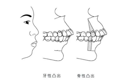 牙性凸出和骨性突出图示