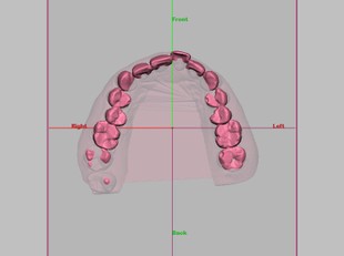 舌侧矫正牙齿CT图片展示