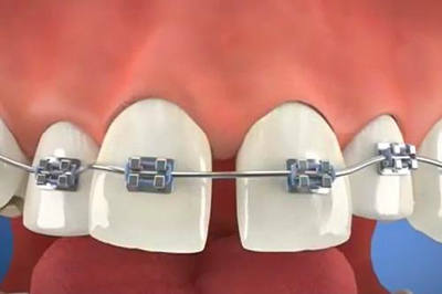 牙齿矫正改善牙缝大