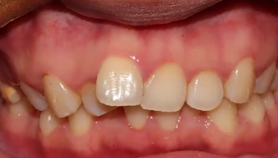 牙齿矫正之前牙周清洁