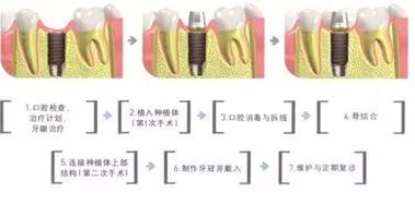 种植牙过程