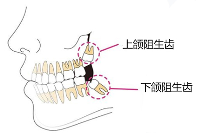 上颌阻生齿与下颌阻生齿