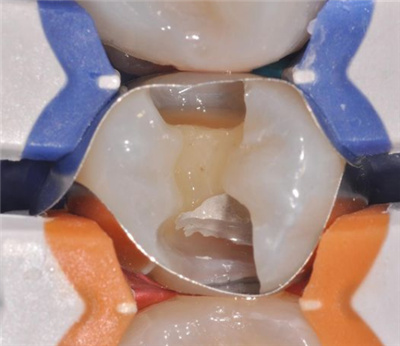 牙齿两侧龋坏进行修复前