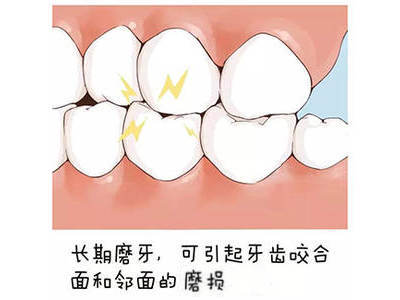 磨牙会引起牙齿咬合面的磨损