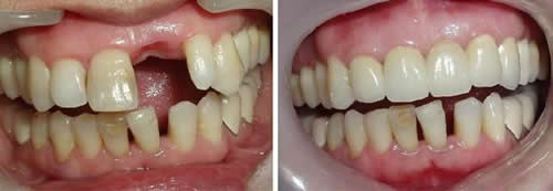 前牙缺失牙冠修复照片对比