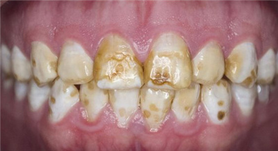 生活中常见的氟斑牙