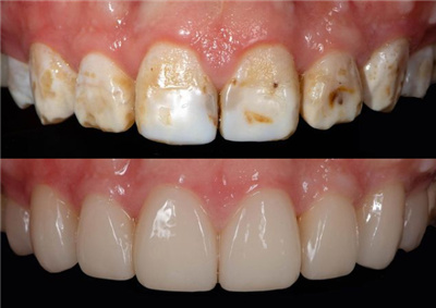 氟斑牙采用牙冠修复前后对比