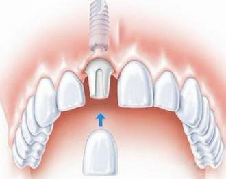 门牙种植牙