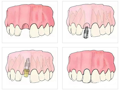 种植牙过程图解