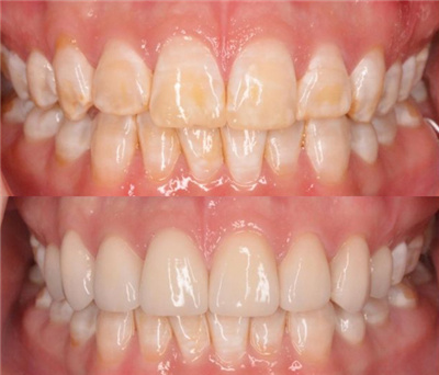 氟斑牙采用牙齿贴面修复后对比结果