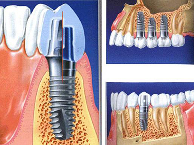 种植牙