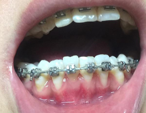 牙齿矫正导致牙龈萎缩