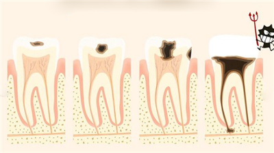 牙齿龋坏各阶段图