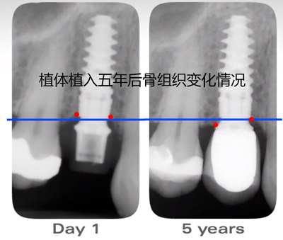 诺贝尔NobelActive植入后五年对比