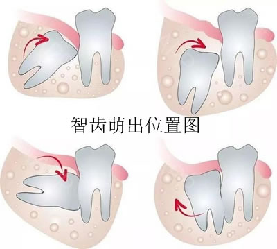 智齿萌出位置图片