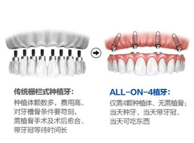 传统种植牙和all-on-4种植牙对比