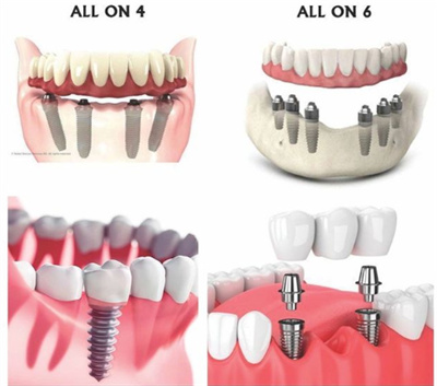 all-on-4 all-on-6全口种植牙展示