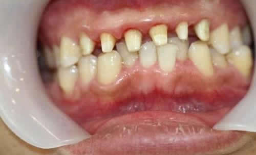 佩戴牙冠后的牙齿情况展示