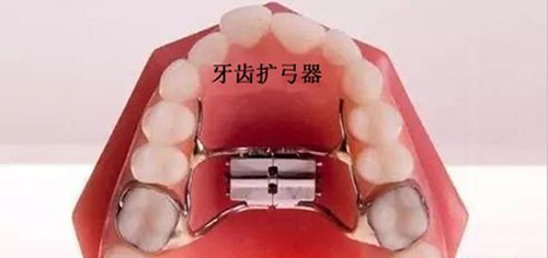 牙齿扩弓器示意图