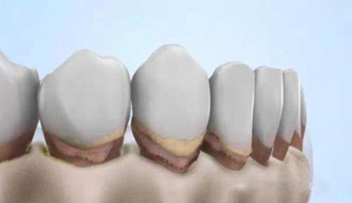 牙齿缺失会导致牙槽骨萎缩