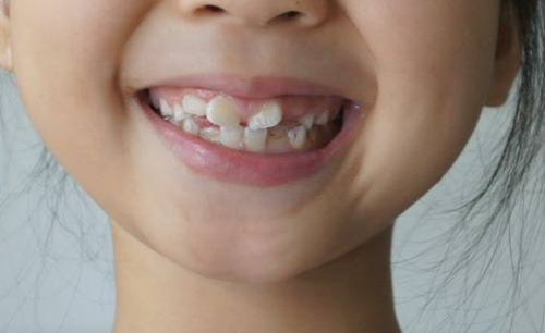 儿童牙问题照片