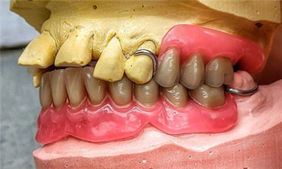 一颗牙活动义齿图片图片